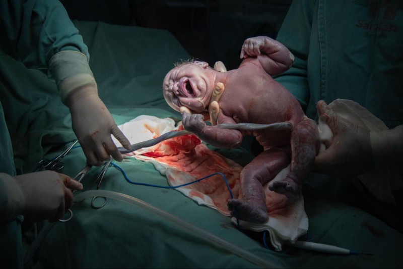 Normal Delivery vs C-Section: Making an Informed Choice for Childbirth